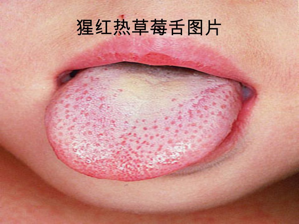 猩红热草莓舌图片