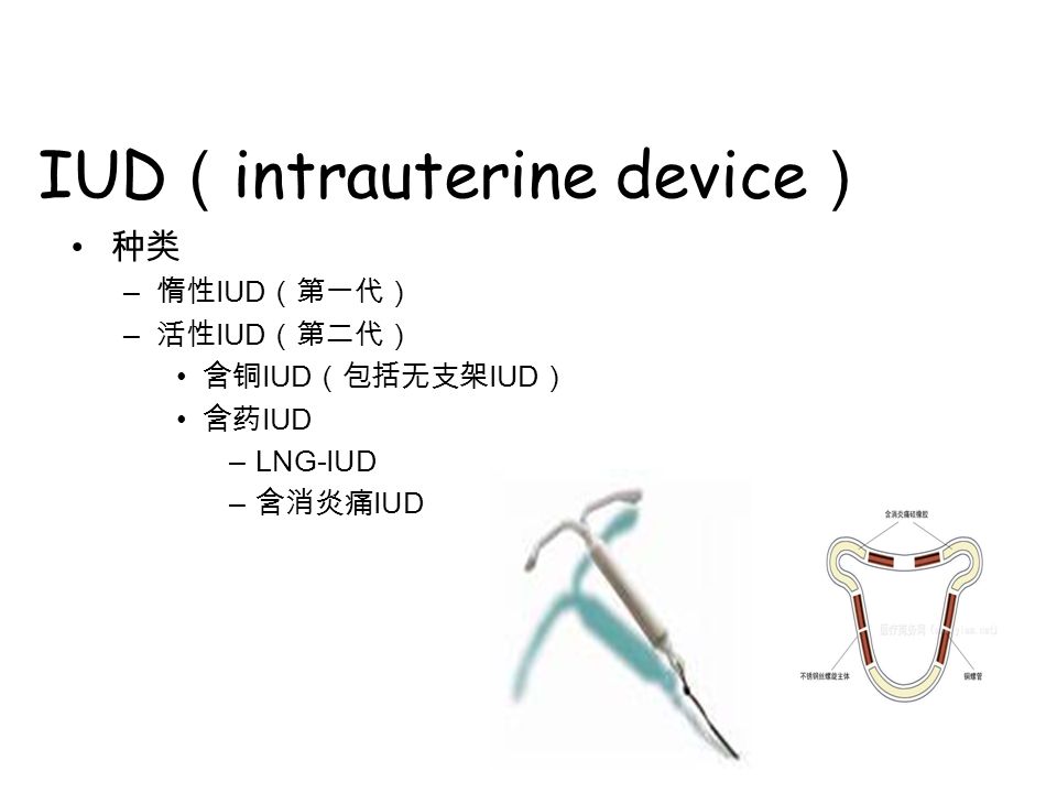 IUD （ intrauterine device ） 种类 – 惰性 IUD （第一代） – 活性 IUD （第二代） 含铜 IUD （包括无支架 IUD ） 含药 IUD –LNG-IUD – 含消炎痛 IUD