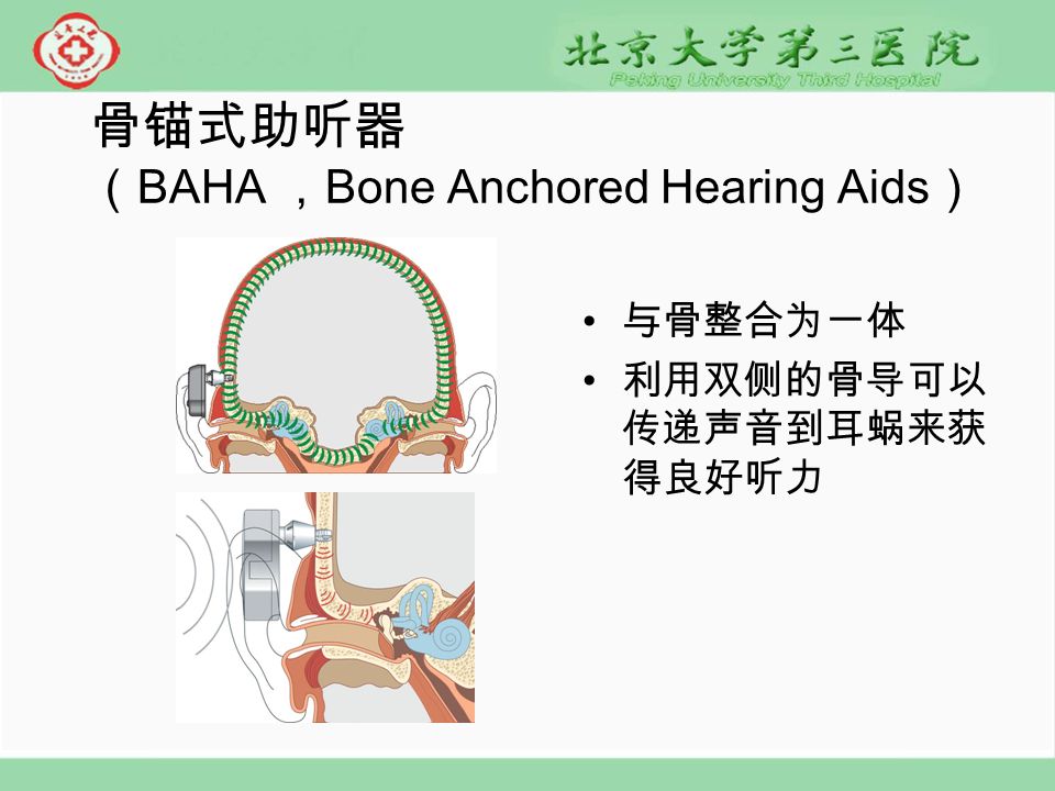 骨锚式助听器 （ BAHA ， Bone Anchored Hearing Aids ） 与骨整合为一体 利用双侧的骨导可以 传递声音到耳蜗来获 得良好听力