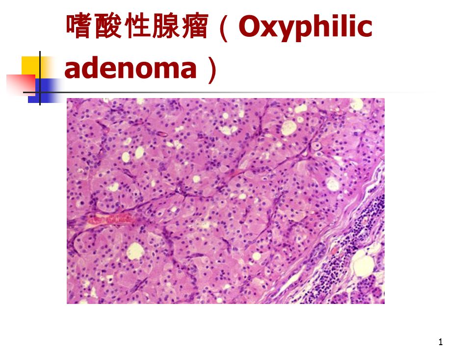 1 嗜酸性腺瘤（ Oxyphilic adenoma ）