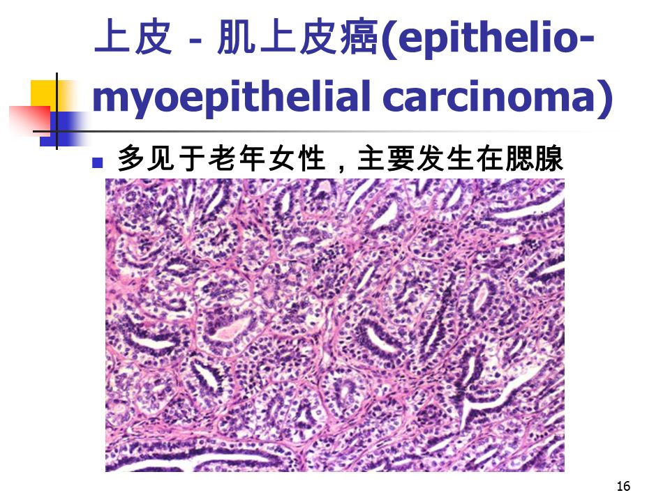 16 上皮－肌上皮癌 (epithelio- myoepithelial carcinoma) 多见于老年女性，主要发生在腮腺