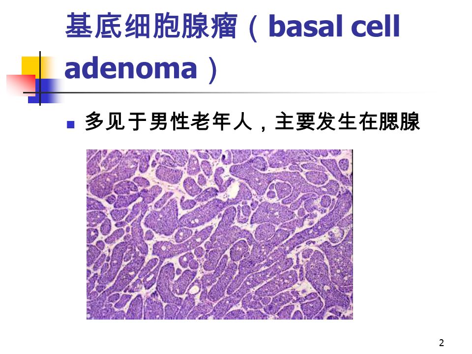 2 基底细胞腺瘤（ basal cell adenoma ） 多见于男性老年人，主要发生在腮腺
