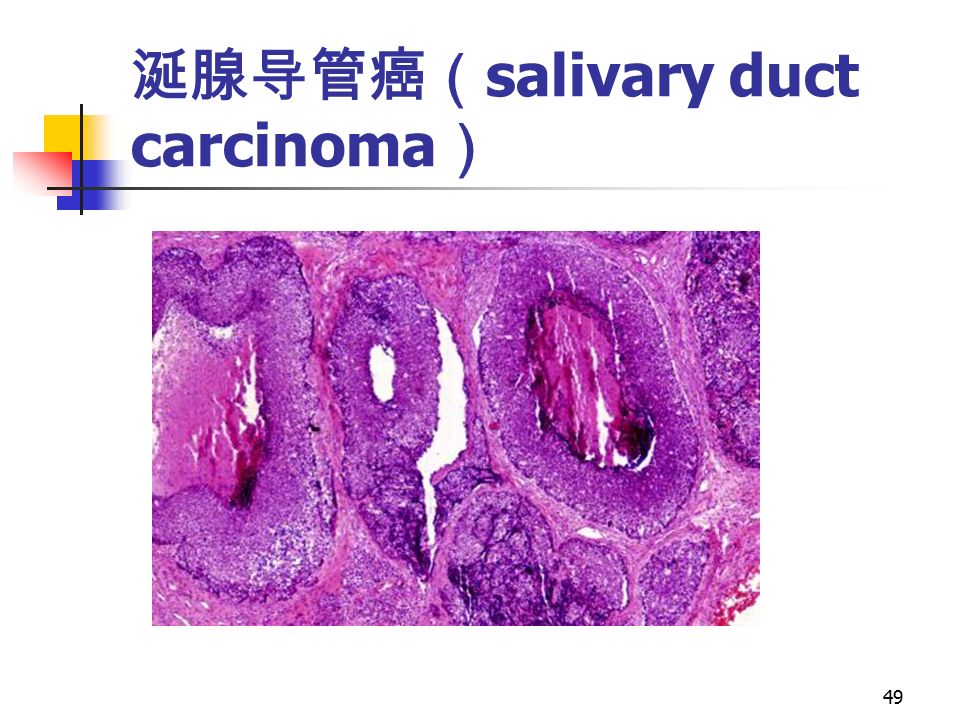 49 涎腺导管癌（ salivary duct carcinoma ）