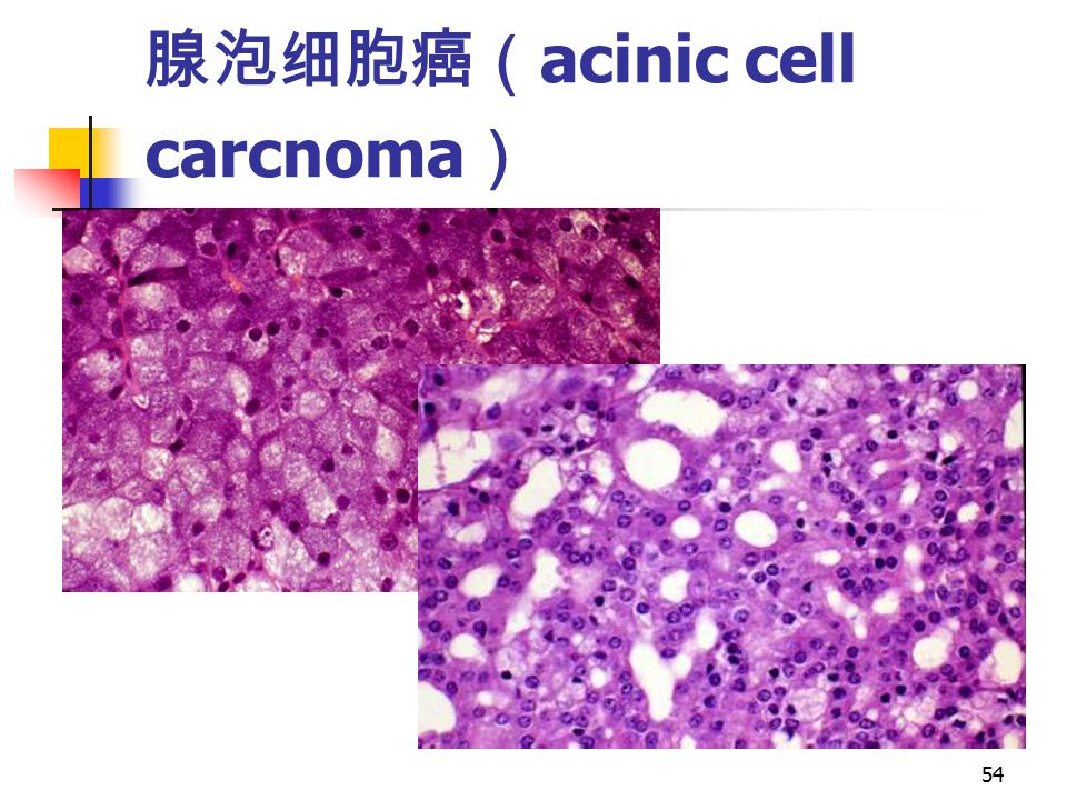 54 腺泡细胞癌（ acinic cell carcnoma ）
