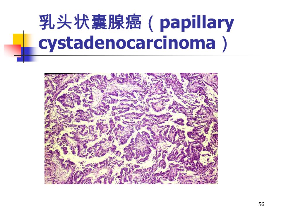 56 乳头状囊腺癌（ papillary cystadenocarcinoma ）