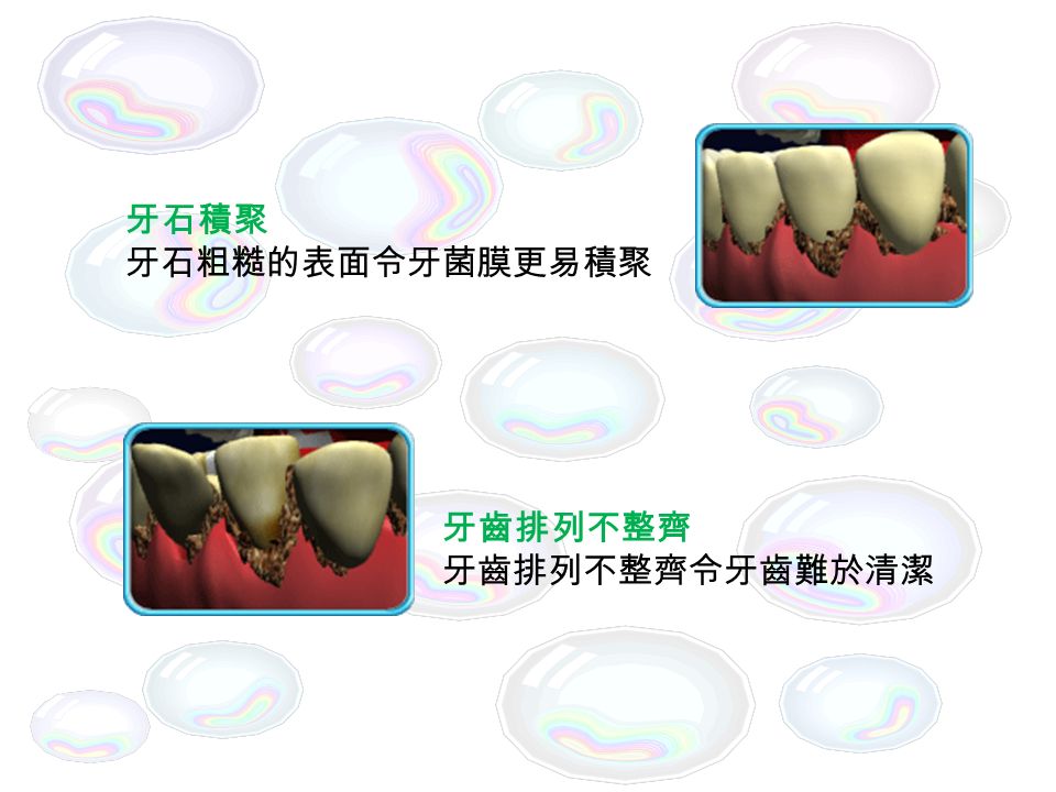 那些人會容易患上牙周病 . 牙周病是牙齒周圍組織的疾病。由積聚在牙齦 ( 牙肉 ) 邊緣的牙菌膜分泌毒素令牙周組織發炎所引致。 如果有以下情況，就會容易患上牙周病。 1.