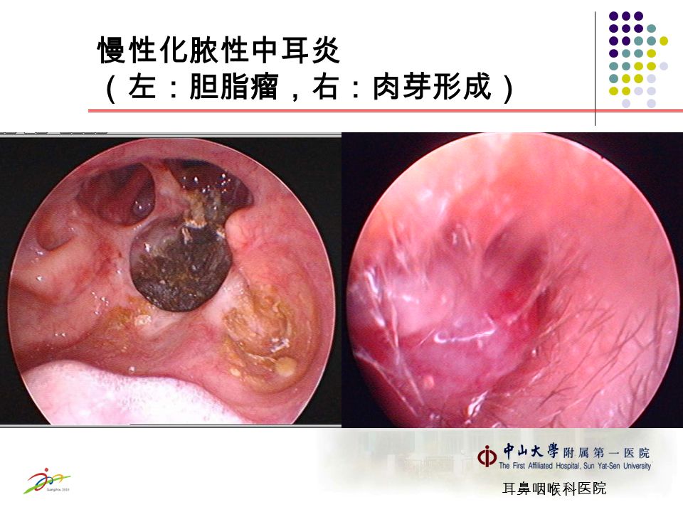 耳鼻咽喉科医院 慢性化脓性中耳炎 （左：胆脂瘤，右：肉芽形成）
