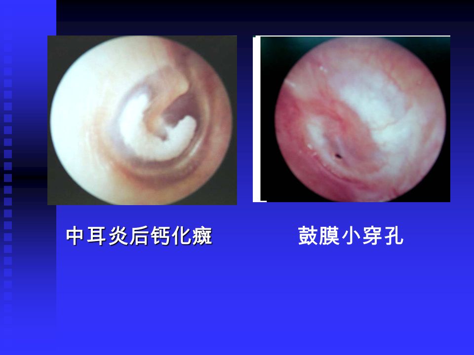 中耳炎后钙化癍鼓膜小穿孔