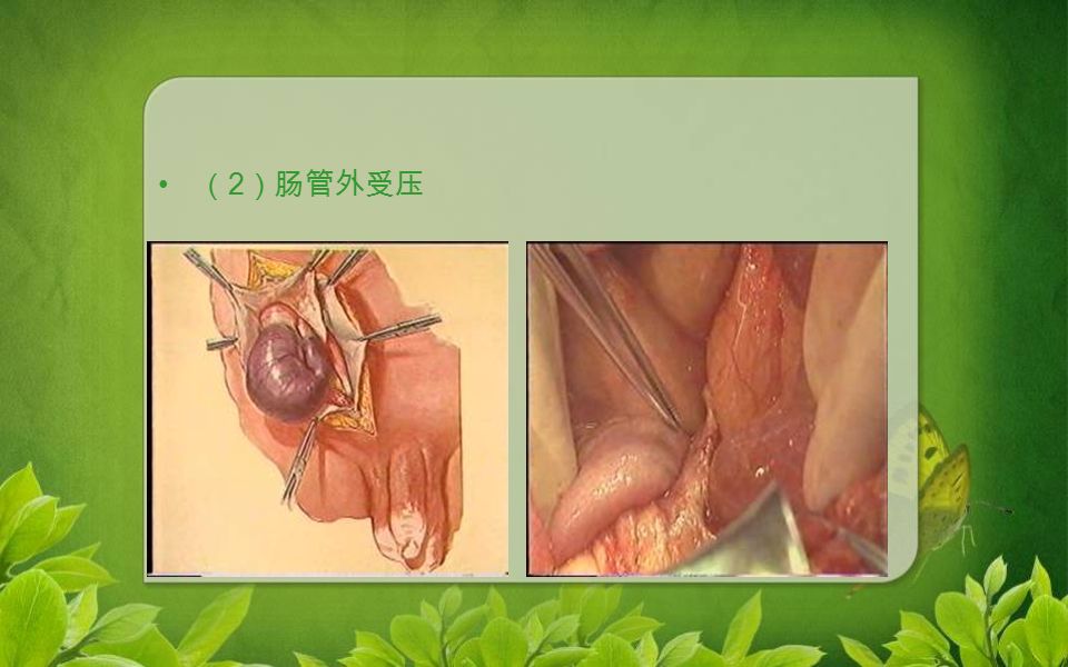 （ 2 ）肠管外受压