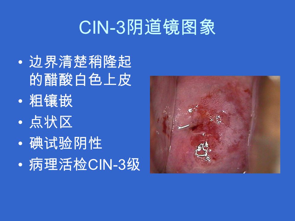 CIN-3 阴道镜图象 边界清楚稍隆起 的醋酸白色上皮 粗镶嵌 点状区 碘试验阴性 病理活检 CIN-3 级