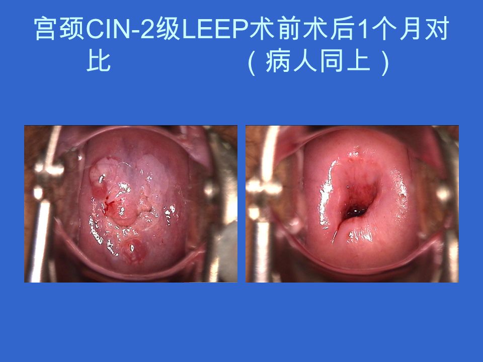 宫颈 CIN-2 级 LEEP 术前术后 1 个月对 比 （病人同上）