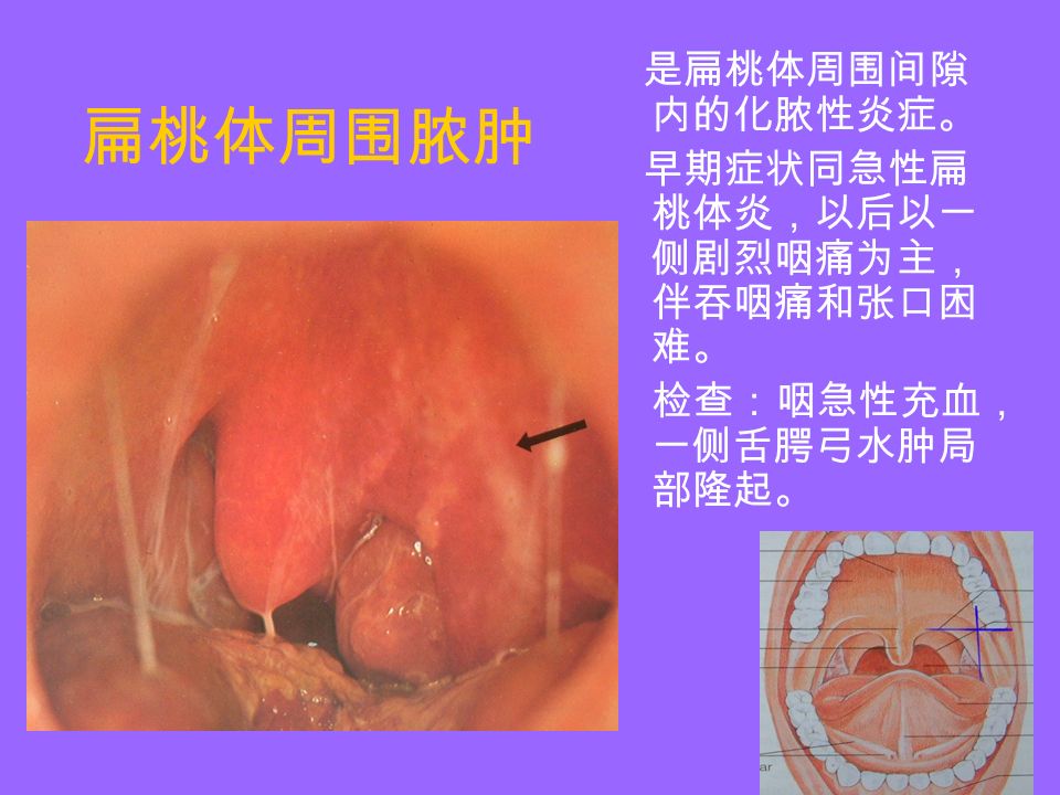 扁桃体周围脓肿 是扁桃体周围间隙 内的化脓性炎症。 早期症状同急性扁 桃体炎，以后以一 侧剧烈咽痛为主， 伴吞咽痛和张口困 难。 检查：咽急性充血， 一侧舌腭弓水肿局 部隆起。