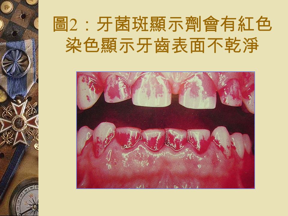圖 2 ：牙菌斑顯示劑會有紅色 染色顯示牙齒表面不乾淨