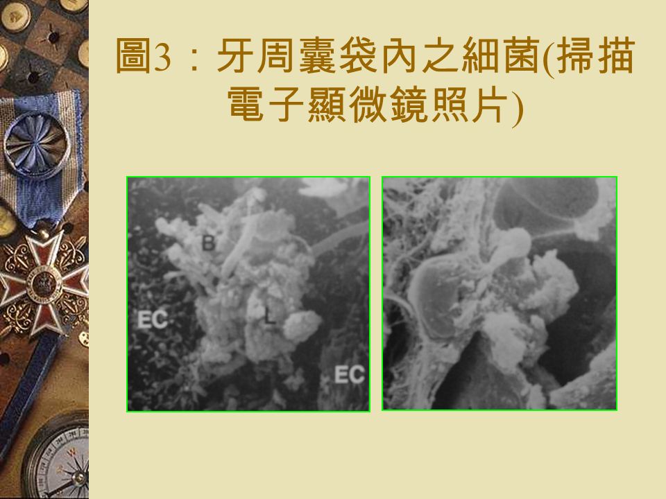 圖 3 ：牙周囊袋內之細菌 ( 掃描 電子顯微鏡照片 )