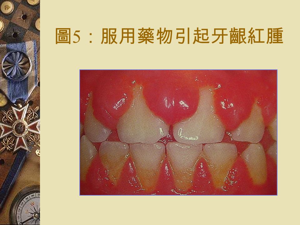 圖 5 ：服用藥物引起牙齦紅腫