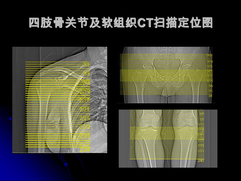四肢骨关节及软组织 CT 扫描定位图