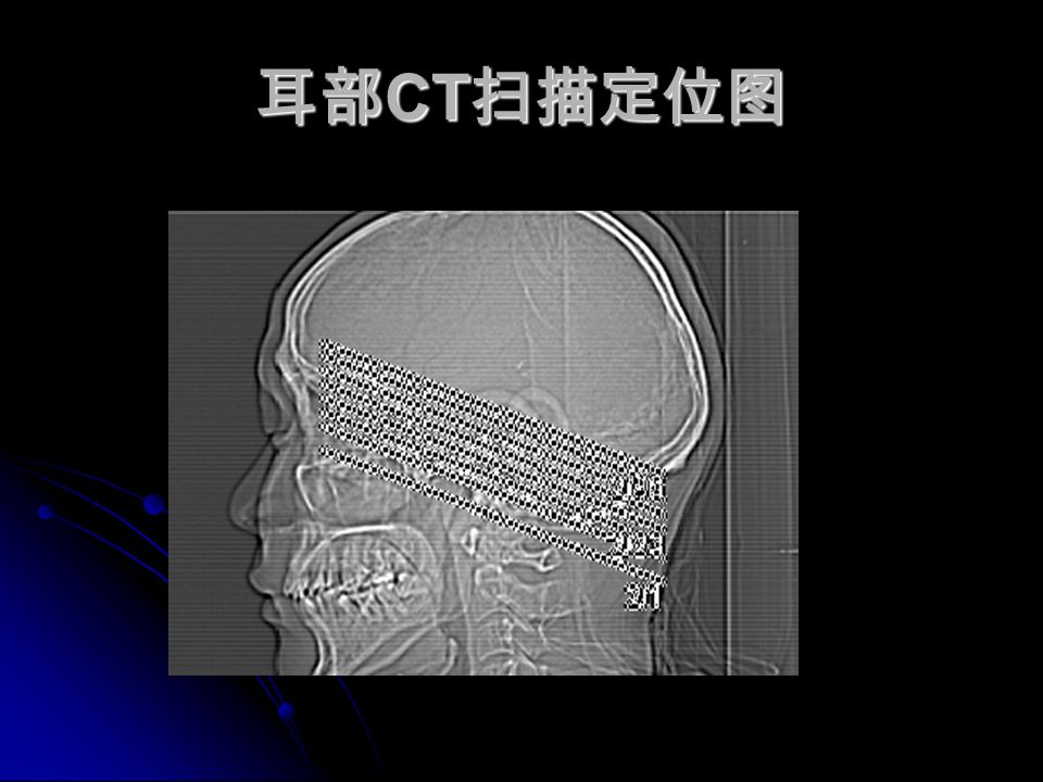 耳部 CT 扫描定位图