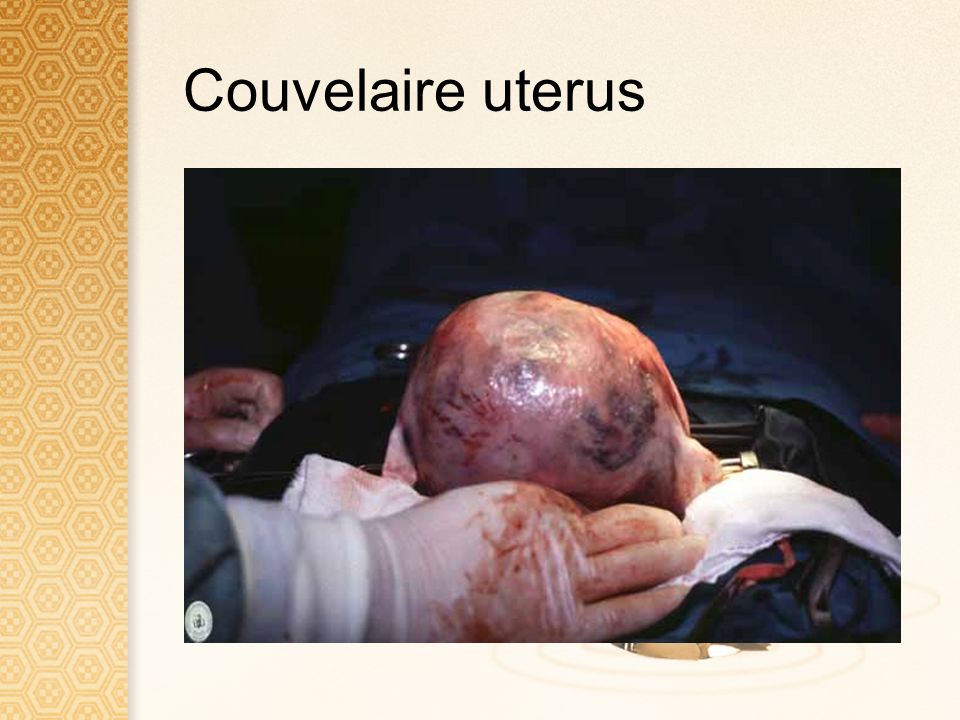 Couvelaire uterus
