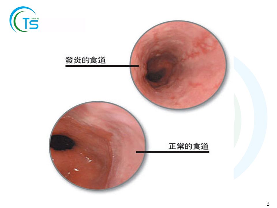 图片食道炎re食管食管粘膜破损怎样治慢性隆起性食道炎食道组织结构图