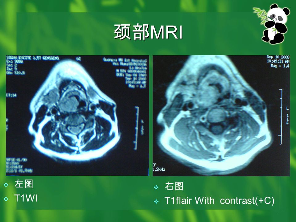 颈部 MRI  左图  T1WI  右图  T1flair With contrast(+C)
