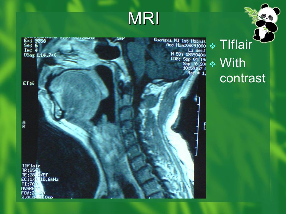 MRI  TIflair  With contrast