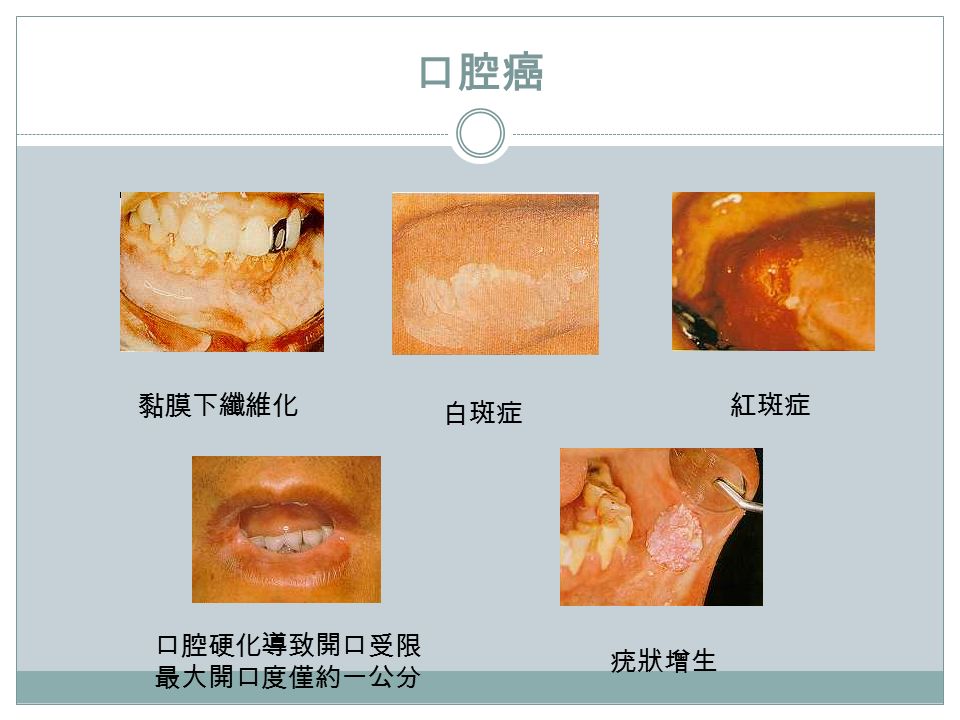 口腔癌 黏膜下纤维化红斑症 白斑症 口腔硬化导致开口受限 最大开口