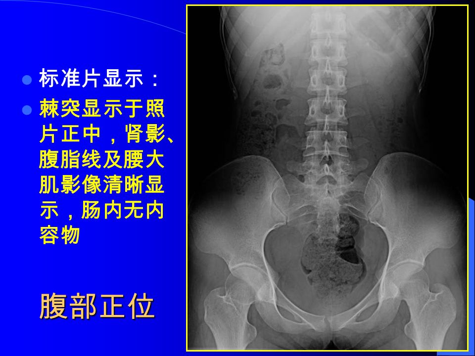 腹部正位 标准片显示： 棘突显示于照 片正中，肾影、 腹脂线及腰大 肌影像清晰显 示，肠内无内 容物