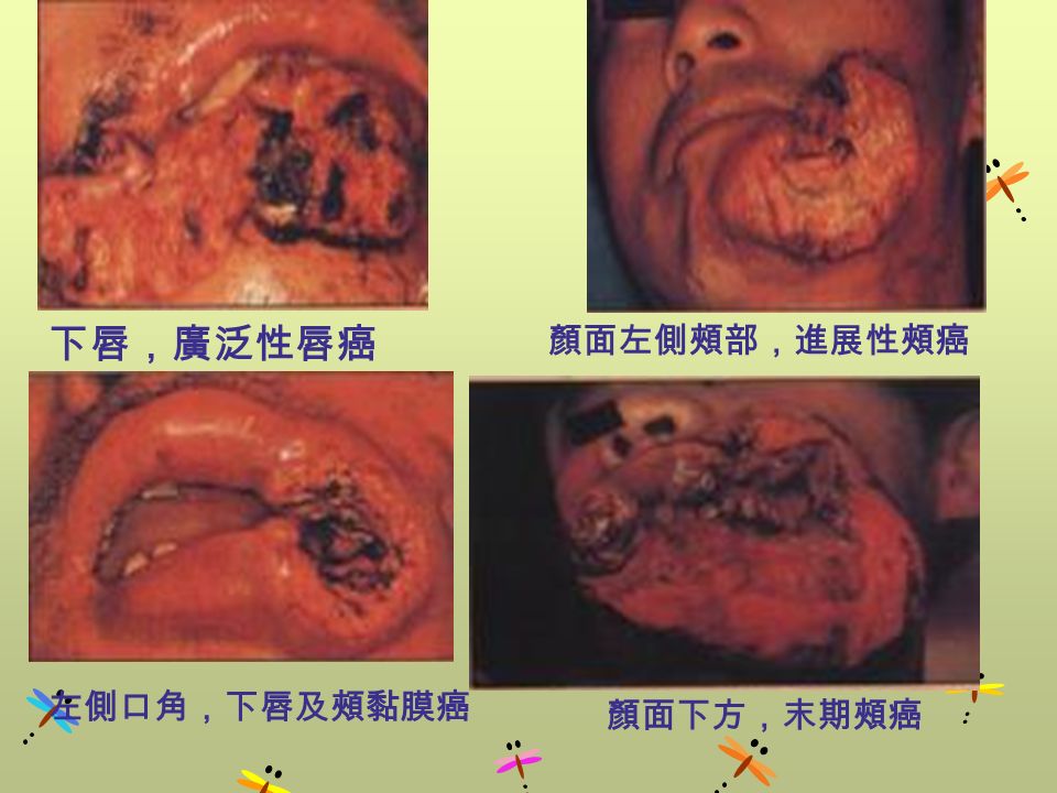 下唇，廣泛性唇癌 顏面左側頰部，進展性頰癌 左側口角，下唇及頰黏膜癌 顏面下方，末期頰癌