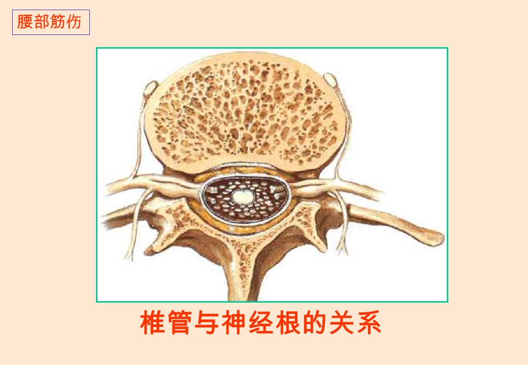 椎管与神经根的关系 腰部筋伤