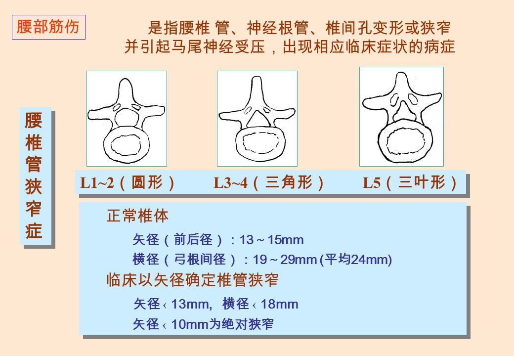 L1~2 （圆形） L3~4 （三角形） L5 （三叶形） 正常椎体 矢径（前后径）： 13 ～ 15mm 横径（弓根间径）： 19 ～ 29mm ( 平均 24mm) 临床以矢径确定椎管狭窄 矢径 ‹ 13mm, 横径 ‹ 18mm 矢径 ‹ 10mm 为绝对狭窄 腰椎管狭窄症腰椎管狭窄症 腰椎管狭窄症腰椎管狭窄症 腰部筋伤 是指腰椎 管、神经根管、椎间孔变形或狭窄 并引起马尾神经受压，出现相应临床症状的病症
