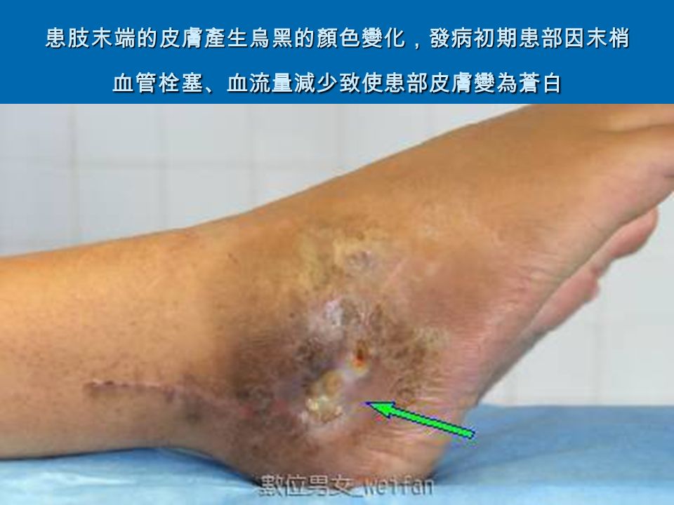患肢末端的皮膚產生烏黑的顏色變化，發病初期患部因末梢 血管栓塞、血流量減少致使患部皮膚變為蒼白