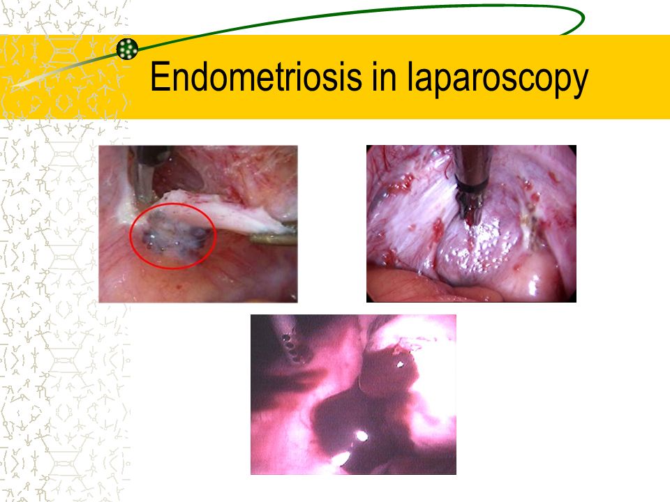 Endometriosis in laparoscopy