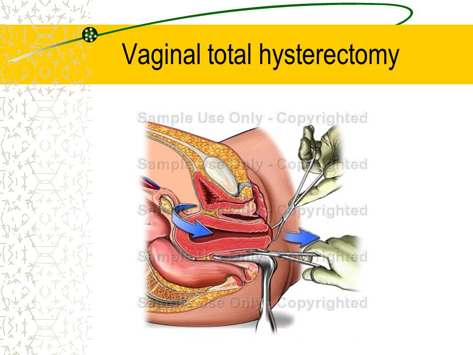 Vaginal total hysterectomy
