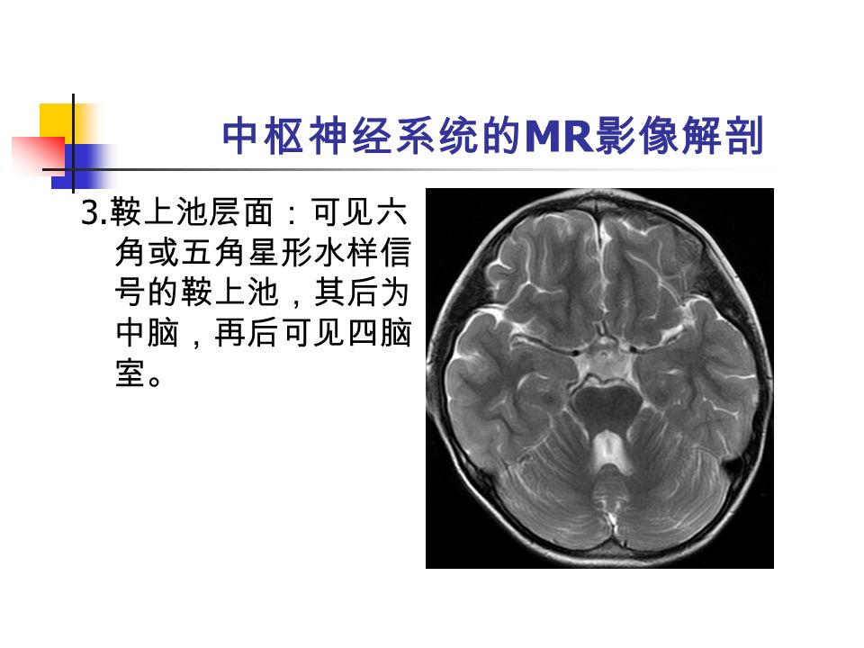 中枢神经系统的 MR 影像解剖 3. 鞍上池层面：可见六 角或五角星形水样信 号的鞍上池，其后为 中脑，再后可见四脑 室。
