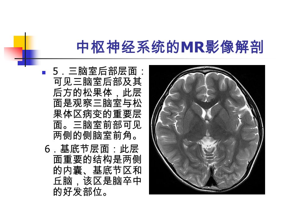 中枢神经系统的 MR 影像解剖 5 ．三脑室后部层面： 可见三脑室后部及其 后方的松果体，此层 面是观察三脑室与松 果体区病变的重要层 面。三脑室前部可见 两侧的侧脑室前角。 6 ．基底节层面：此层 面重要的结构是两侧 的内囊、基底节区和 丘脑，该区是脑卒中 的好发部位。