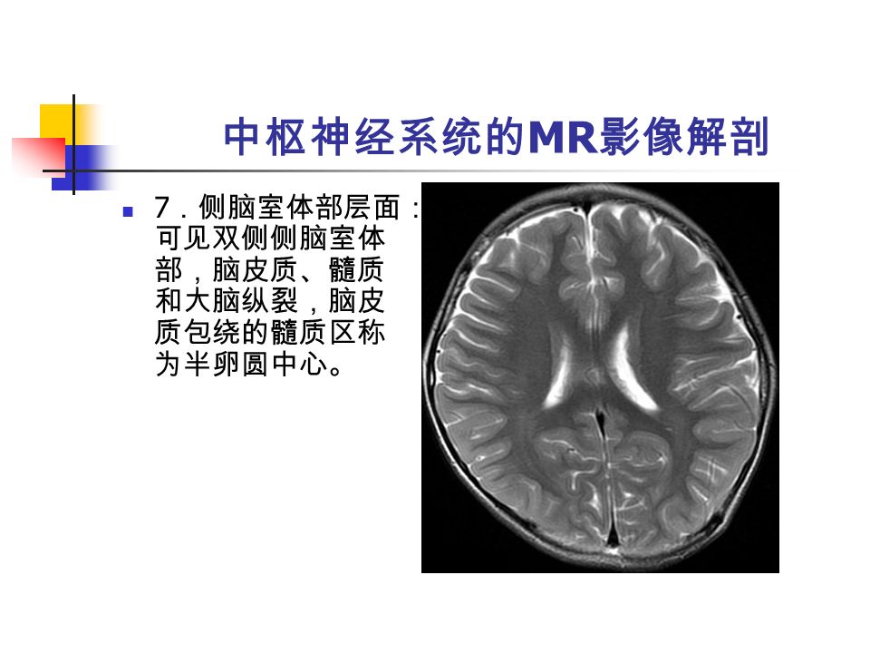 中枢神经系统的 MR 影像解剖 7 ．侧脑室体部层面： 可见双侧侧脑室体 部，脑皮质、髓质 和大脑纵裂，脑皮 质包绕的髓质区称 为半卵圆中心。