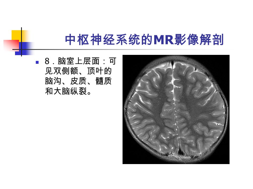 中枢神经系统的 MR 影像解剖 8 ．脑室上层面：可 见双侧额、顶叶的 脑沟、皮质、髓质 和大脑纵裂。