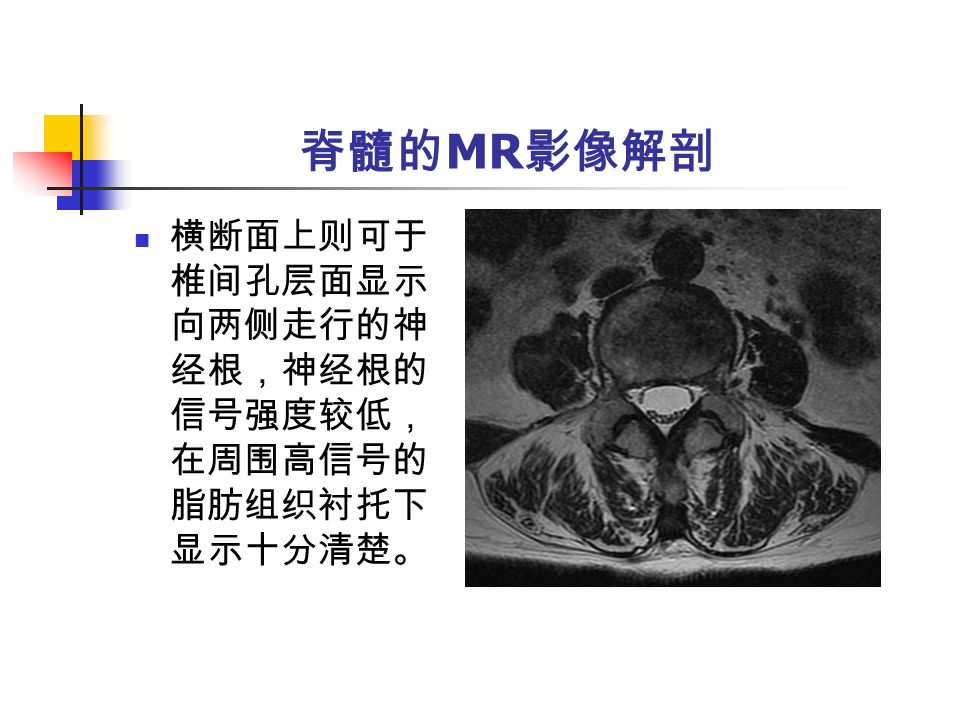 脊髓的 MR 影像解剖 横断面上则可于 椎间孔层面显示 向两侧走行的神 经根，神经根的 信号强度较低， 在周围高信号的 脂肪组织衬托下 显示十分清楚。