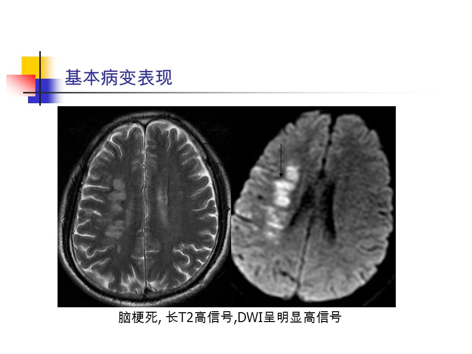 基本病变表现 脑梗死, 长 T2 高信号,DWI 呈明显高信号