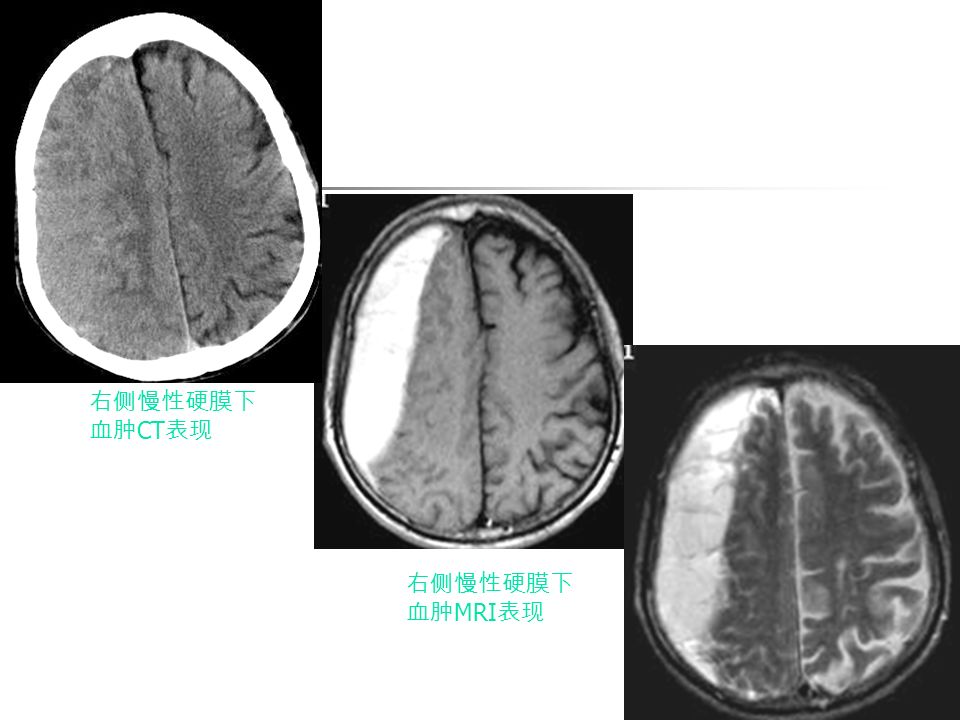右侧慢性硬膜下 血肿 CT 表现 右侧慢性硬膜下 血肿 MRI 表现