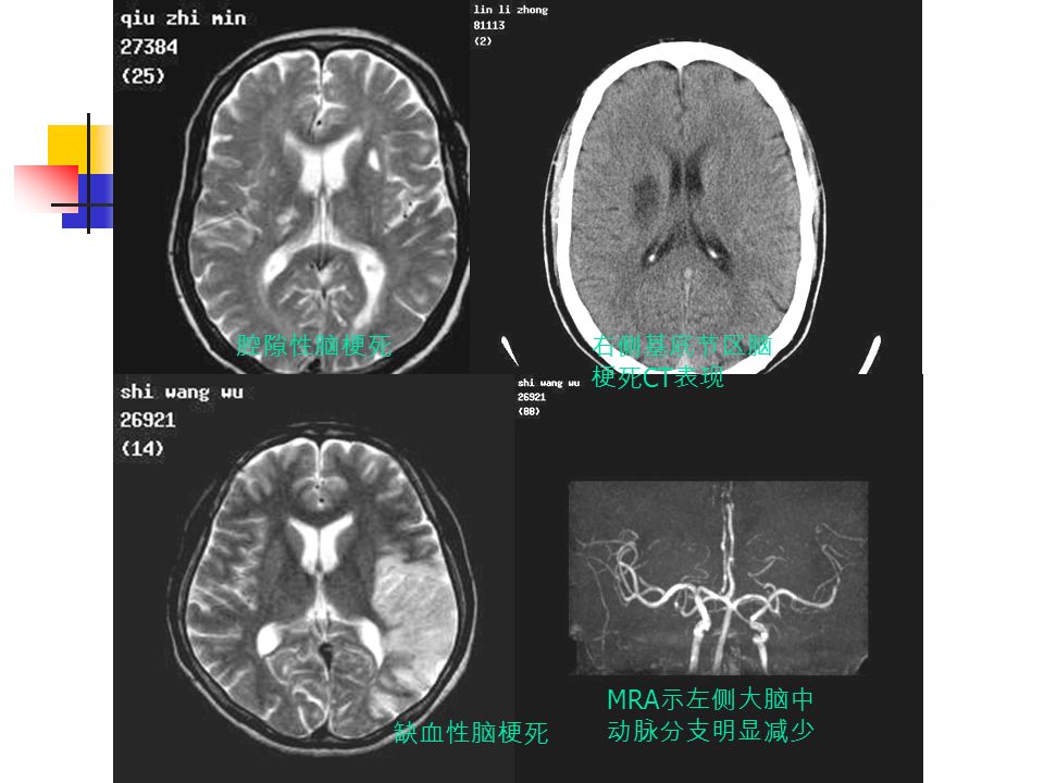 腔隙性脑梗死 缺血性脑梗死 MRA 示左侧大脑中 动脉分支明显减少 右侧基底节区脑 梗死 CT 表现