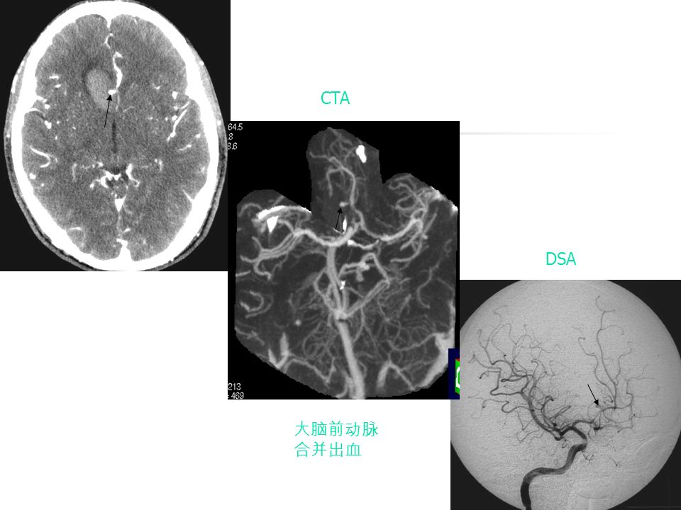 大脑前动脉 合并出血 CTA DSA