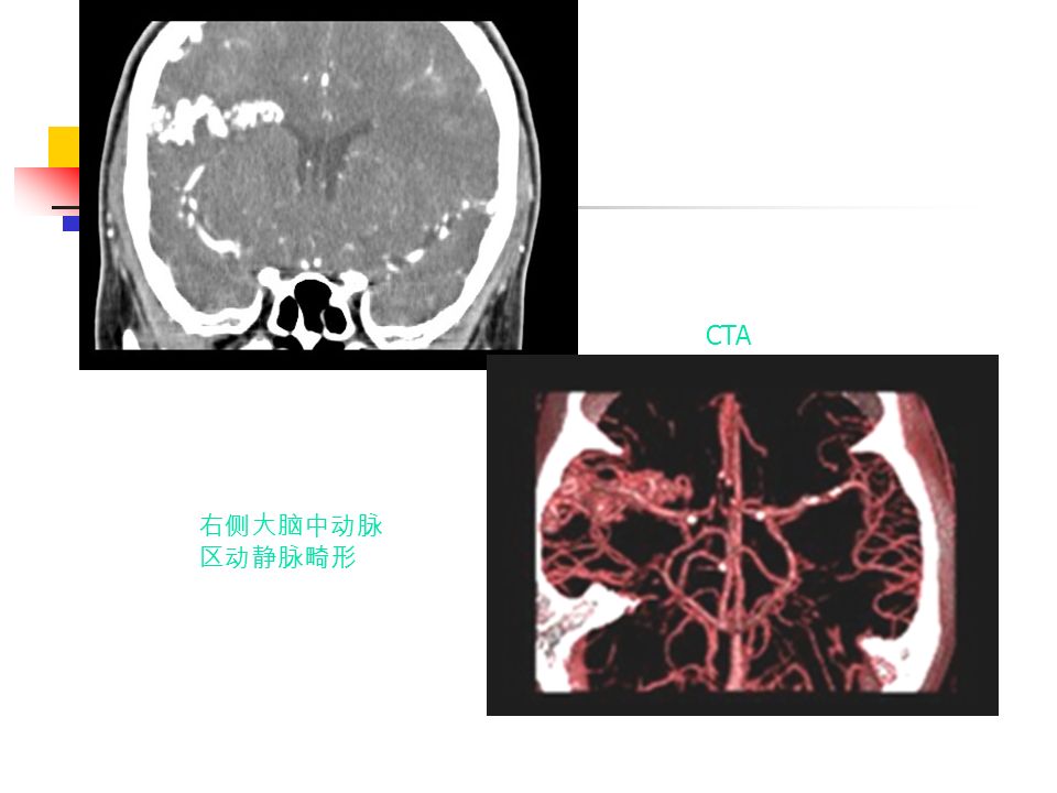 右侧大脑中动脉 区动静脉畸形 CTA