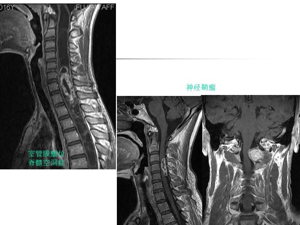 神经鞘瘤 室管膜瘤位 脊髓空洞症