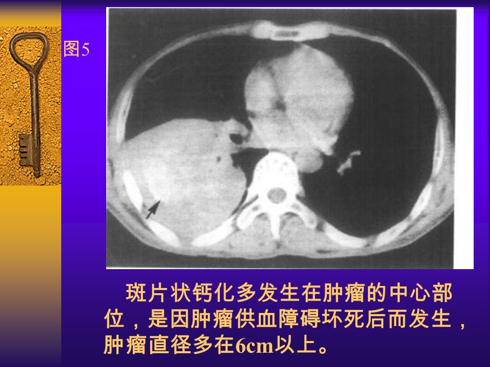 图5图5 斑片状钙化多发生在肿瘤的中心部 位，是因肿瘤供血障碍坏死后而发生， 肿瘤直径多在 6cm 以上。