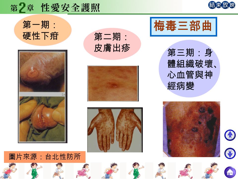 第一期： 硬性下疳 第二期： 皮膚出疹 第三期：身 體組織破壞、 心血管與神 經病變 梅毒三部曲 圖片來源：台北性防所