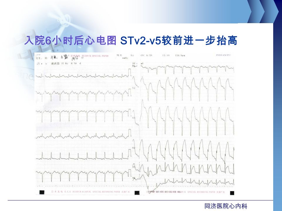 同济医院心内科 入院 6 小时后心电图 STv2-v5 较前进一步抬高