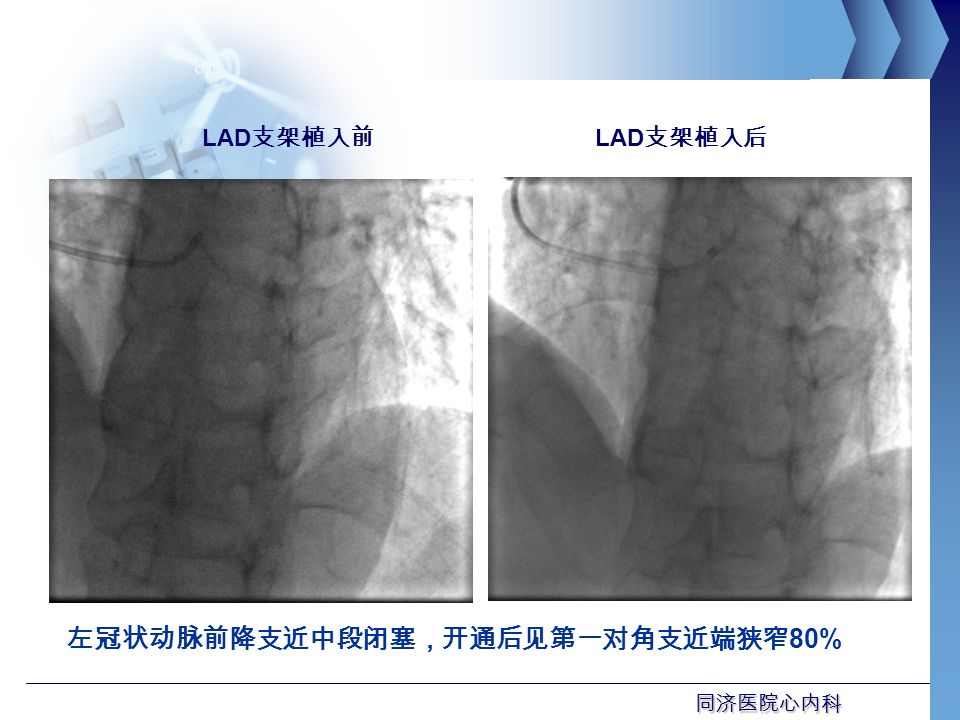 同济医院心内科 LAD 支架植入后 LAD 支架植入前 左冠状动脉前降支近中段闭塞，开通后见第一对角支近端狭窄 80%