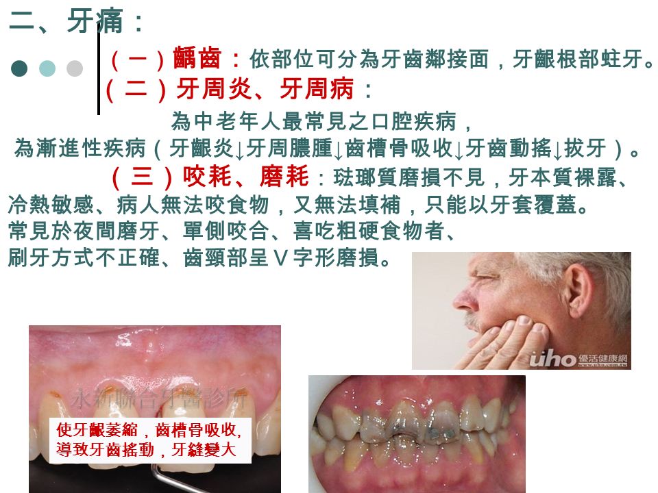 二、牙痛： （一） 齲齒： 依部位可分為牙齒鄰接面，牙齦根部蛀牙。 （二）牙周炎、牙周病： 為中老年人最常見之口腔疾病， 為漸進性疾病（牙齦炎 ↓ 牙周膿腫 ↓ 齒槽骨吸收 ↓ 牙齒動搖 ↓ 拔牙）。 （三）咬耗、磨耗 ：琺瑯質磨損不見，牙本質裸露、 冷熱敏感、病人無法咬食物，又無法填補，只能以牙套覆蓋。 常見於夜間磨牙、單側咬合、喜吃粗硬食物者、 刷牙方式不正確、齒頸部呈Ｖ字形磨損。 使牙齦萎縮，齒槽骨吸收, 導致牙齒搖動，牙縫變大