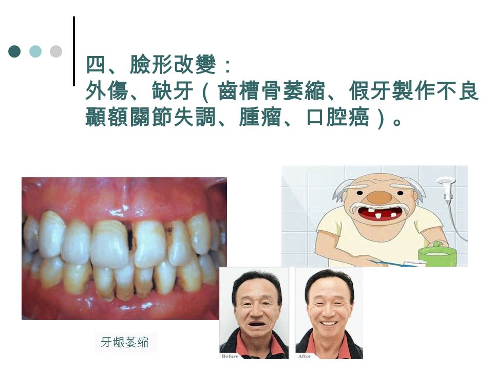 四、臉形改變： 外傷、缺牙（齒槽骨萎縮、假牙製作不良 顳額關節失調、腫瘤、口腔癌）。 牙龈萎缩